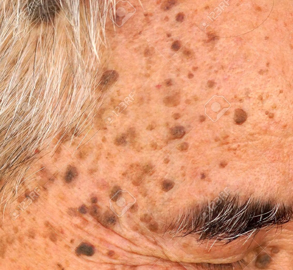 62590383-la-tête-de-la-vieille-asie-homme-plein-de-taches-de-rousseur-et-séborrhéique-kératose-verruca-séborrhéique-verru